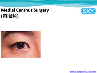 Medial Canthus Surgery
(۽)
www.shanghaiskyclinic.com
 