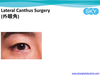 Lateral Canthus Surgery
(۽)
www.shanghaiskyclinic.com
 