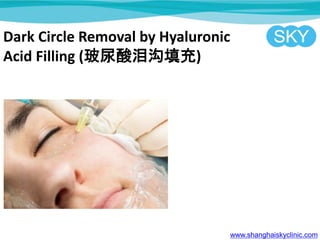 Dark Circle Removal by Hyaluronic
Acid Filling (ṵ)
www.shanghaiskyclinic.com
 