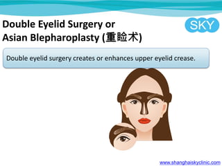 Double Eyelid Surgery or
Asian Blepharoplasty ()
Double eyelid surgery creates or enhances upper eyelid crease.
www.shanghaiskyclinic.com
 