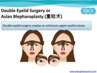 Double Eyelid Surgery or
Asian Blepharoplasty ()
Double eyelid surgery creates or enhances upper eyelid crease.
www.shanghaiskyclinic.com
 