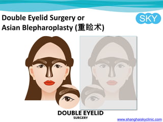 Double Eyelid Surgery or
Asian Blepharoplasty ()
www.shanghaiskyclinic.com
 
