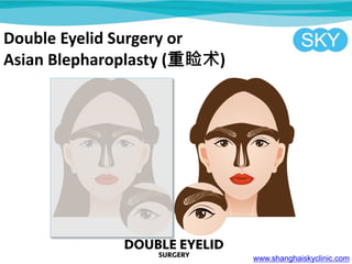 Double Eyelid Surgery or
Asian Blepharoplasty ()
www.shanghaiskyclinic.com
 