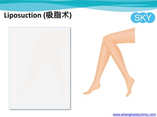 www.shanghaiskyclinic.com
Liposuction (吸脂术)
 