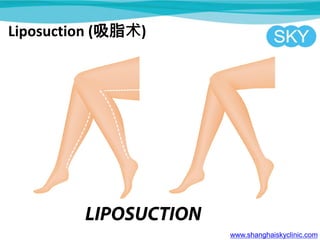 www.shanghaiskyclinic.com
Liposuction (吸脂术)
 
