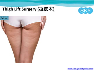 Thigh Lift Surgery (拉皮术)
www.shanghaiskyclinic.com
Before
 