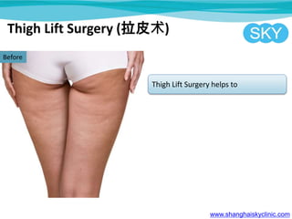 Thigh Lift Surgery (拉皮术)
www.shanghaiskyclinic.com
Before
Thigh Lift Surgery helps to
 