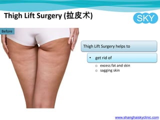Thigh Lift Surgery (拉皮术)
www.shanghaiskyclinic.com
Before
Thigh Lift Surgery helps to
• get rid of
o excess fat and skin
o sagging skin
 