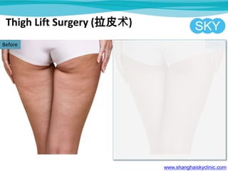 Thigh Lift Surgery (拉皮术)
www.shanghaiskyclinic.com
Before After
 