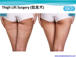 Thigh Lift Surgery (拉皮术)
www.shanghaiskyclinic.com
Before After
 