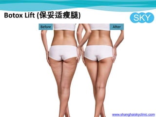 Before After
www.shanghaiskyclinic.com
Botox Lift (保妥适瘦腿)
 