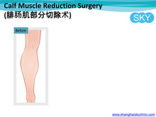 Calf Muscle Reduction Surgery
(腓肠肌部分切除术)
www.shanghaiskyclinic.com
Before
 