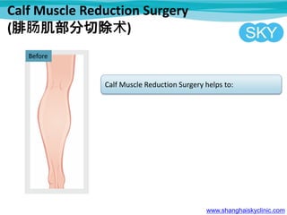 Calf Muscle Reduction Surgery
(腓肠肌部分切除术)
www.shanghaiskyclinic.com
Before
Calf Muscle Reduction Surgery helps to:
 