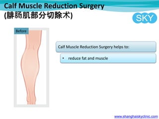 Calf Muscle Reduction Surgery
(腓肠肌部分切除术)
www.shanghaiskyclinic.com
Before
Calf Muscle Reduction Surgery helps to:
• reduce fat and muscle
 