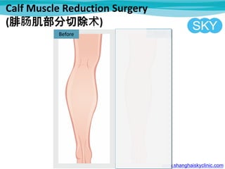 Calf Muscle Reduction Surgery
(腓肠肌部分切除术)
Before
www.shanghaiskyclinic.com
After
 