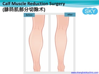 Calf Muscle Reduction Surgery
(腓肠肌部分切除术)
Before
www.shanghaiskyclinic.com
After
 