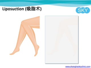 www.shanghaiskyclinic.com
Liposuction (吸脂术)
 