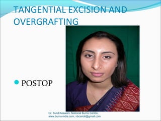 Cosmetic surgery by Dr. Sunil Keswani, National Burns Centre, Airoli | PPT