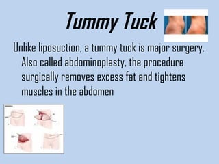 Tummy Tuck
Unlike liposuction, a tummy tuck is major surgery.
Also called abdominoplasty, the procedure
surgically removes excess fat and tightens
muscles in the abdomen

 
