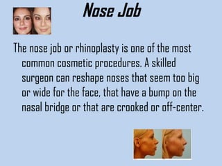 Nose Job
The nose job or rhinoplasty is one of the most
common cosmetic procedures. A skilled
surgeon can reshape noses that seem too big
or wide for the face, that have a bump on the
nasal bridge or that are crooked or off-center. 

 
