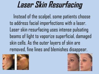 Laser Skin Resurfacing
Instead of the scalpel, some patients choose
to address facial imperfections with a laser.
Laser skin resurfacing uses intense pulsating
beams of light to vaporize superficial, damaged
skin cells. As the outer layers of skin are
removed, fine lines and blemishes disappear.

 