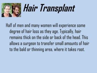 Hair Transplant
Half of men and many women will experience some
degree of hair loss as they age. Typically, hair
remains thick on the side or back of the head. This
allows a surgeon to transfer small amounts of hair
to the bald or thinning area, where it takes root. 

 