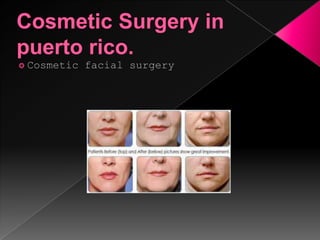 Cosmetic surgery