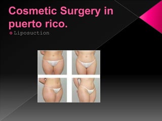 Cosmetic surgery