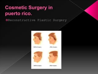 Cosmetic Surgery in puerto rico.Cosmetic facial surgeryCosmetic Surgery in puerto rico.LiposuctionCosmetic Surgery in puerto rico.Abdominal PlasticCosmetic Surgery in puerto rico.Gluteal augmentationCosmetic Surgery in puerto rico.RhynoplastyCosmetic Surgery in puerto rico.BotoxCosmetic Surgery in puerto rico.Injectables FillersResources:Dra. Ana T. Santos Quiñones. (2007). About Bariatric Surgery. Retrieved from http://www.cirugiabariatricapr.com/Calero Fernando M. Plastic Surgery. Retrieved from http://www.myglobalprofile.com/calero-fernando-m/Dr. Claudio Corral. Cirugía Plástica estética de avanzada en Puerto Rico. Retrieved from http://www.edenesthetics.com/Zapolnik, C.(n. d.). Different types of plastic surgery. Retrieved from http://www.ehow.com/about_4778863_different-types-plastic-surgery.htmlDra. Marcela Yépez Intriago. (2010). Edad adecuada para una cirugía plástica. Retrieved from http://www.cirugiaplasticaecuador.com.ec/articulos/archives/edad-adecuada-para-una-cirugia-plasticaKaminer, Michael S., Jeffrey S. Dover, and Kenneth A. Arndt. Atlas of CosmeticSurgery. Philadelphia: Saunders, (2002). Retrievedfromhttp://www.surgeryencyclopedia.com/Pa-St/Plastic-Reconstructive-and-Cosmetic-Surgery.html#ixzz1OPl8VdCg