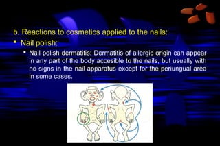 b. Reactions to cosmetics applied to the nails:
 Nail polish:
 Nail polish dermatitis: Dermatitis of allergic origin can appear
in any part of the body accesible to the nails, but usually with
no signs in the nail apparatus except for the periungual area
in some cases.

 