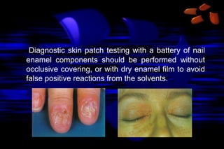 Diagnostic skin patch testing with a battery of nail
enamel components should be performed without
occlusive covering, or with dry enamel film to avoid
false positive reactions from the solvents.

 
