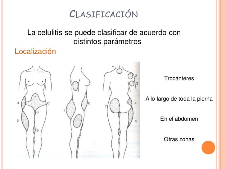 Celulitis