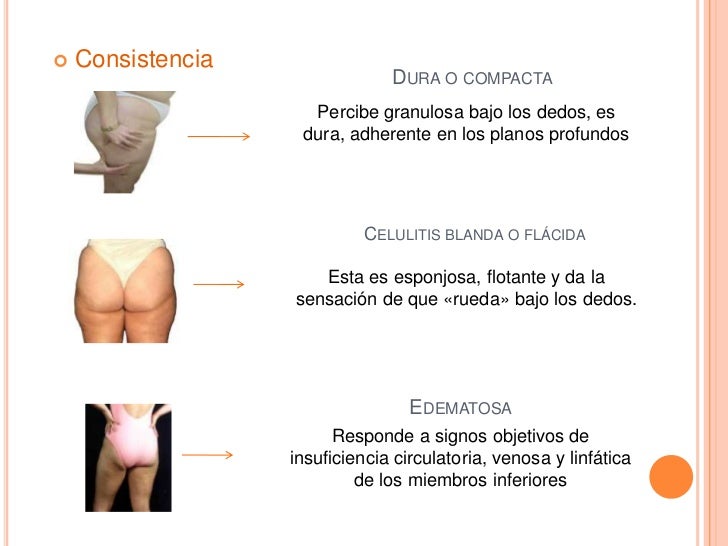 Celulitis Celulitis