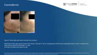 Figure 5: Phenol light peel before and after four sessions.
Reproduced under Open Access charter from: Garg S, Tuknayat A. Tips for managing post-inflammatory hyperpigmentation of acne. Available from:
https://dx.doi.org/10.25259/CSDM_17_2021
Cosmoderma (https://cosmoderma.org)
Cosmoderma
Licence:This is an open-access article distributed under the terms of the Creative Commons Attribution-Non Commercial-Share Alike 4.0 License (https://creativecommons.org/licenses/by-nc-sa/4.0/), which allows others to remix,
tweak, and build upon the work non-commercially, as long as the author is credited and the new creations are licensed under the identical terms.
 