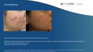 Figure 10: Acne 420 laser for active acne and PIH before and after three sessions.
Reproduced under Open Access charter from: Garg S, Tuknayat A. Tips for managing post-inflammatory hyperpigmentation of acne. Available from:
https://dx.doi.org/10.25259/CSDM_17_2021
Cosmoderma (https://cosmoderma.org)
Cosmoderma
Licence:This is an open-access article distributed under the terms of the Creative Commons Attribution-Non Commercial-Share Alike 4.0 License (https://creativecommons.org/licenses/by-nc-sa/4.0/), which allows others to remix,
tweak, and build upon the work non-commercially, as long as the author is credited and the new creations are licensed under the identical terms.
 