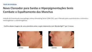 Novo Clareador para Sardas e Hiperpigmentações Senis
Combate o Espalhamento das Manchas
Inibição da Granulocyte-macrophage colony-stimulating factor (GM-CSF), que é liberada pelos queratinócitos e estimula a
melanogênese e a dendritogênese.
Confira abaixo imagens de uma voluntária antes e após tratamento com Wonderlight™ por 2 meses:
ANTES DEPOIS
TESTE DE EFICÁCIA
 