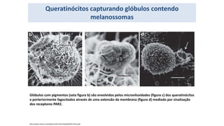 Queratinócitos capturando glóbulos contendo
melanossomas
Glóbulos com pigmentos (seta figura b) são envolvidos pelos microvilosidades (figura c) dos queratinócitos
e porteriormente fagocitados através de uma extensão da membrana (figura d) mediado por sinalização
dos receptores PAR2.
http://www.nature.com/jid/journal/v132/n4/pdf/jid2011413a.pdf
 
