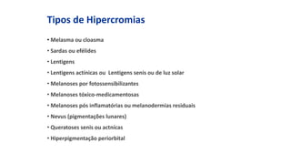 Tipos de Hipercromias
• Melasma ou cloasma
• Sardas ou efélides
• Lentigens
• Lentigens actínicas ou Lentigens senis ou de luz solar
• Melanoses por fotossensibilizantes
• Melanoses tóxico-medicamentosas
• Melanoses pós inflamatórias ou melanodermias residuais
• Nevus (pigmentações lunares)
• Queratoses senis ou actnícas
• Hiperpigmentação periorbital
 