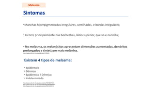 Sintomas
•Manchas hiperpigmentadas irregulares, serrilhadas, e bordas irregulares;
• Ocorre principalmente nas bochechas, lábio superior, queixo e na testa;
• No melasma, os melanócitos apresentam dimensões aumentadas, dendritos
prolongados e sintetizam mais melanina.
http://www.ncbi.nlm.nih.gov/pubmed/15798432
http://www.ncbi.nlm.nih.gov/pmc/articles/PMC2807702/
http://www.ncbi.nlm.nih.gov/pubmedhealth/PMH0003865/
http://www.ncbi.nlm.nih.gov/pmc/articles/PMC3440273/
Melasma
Existem 4 tipos de melasma:
• Epidérmico
• Dérmico
• Epidérmico / Dérmico
• Indeterminado
 