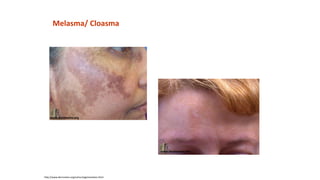 http://www.dermnetnz.org/colour/pigmentation.html
Melasma/ Cloasma
www.dermnetnz.org
www.dermnetnz.org
 