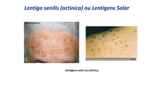 Lentigo senilis (actinica) ou Lentigens Solar
Lentigens solar ou actínica
www.dermnetnz.org
Fitzpatrick's Dermatology In General Medicine (Two Vol. Set) 6th edition (May 23, 2003)
 