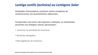 Lentigo senilis (actinica) ou Lentigens Solar
Avaliações microscópicas revelaram vários complexos de
melanossomas nos queratinócitos adjacentes;
Comparados com áreas não expostas a radiação, os melanócitos
presentes nas lentigens solares apresentam:
• Aumento na atividade da tirosinase;
• Dendritos alongados;
• Macroglóbulos de melanina.
Fitzpatrick's Dermatology In General Medicine (Two Vol. Set) 6th edition (May 23, 2003)
 