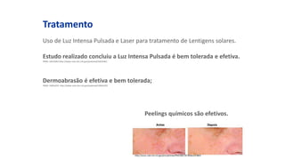 Tratamento
Uso de Luz Intensa Pulsada e Laser para tratamento de Lentigens solares.
Estudo realizado concluiu a Luz Intensa Pulsada é bem tolerada e efetiva.
PMID: 16635661http://www.ncbi.nlm.nih.gov/pubmed/16635661
Dermoabrasão é efetiva e bem tolerada;
PMID: 10816235 http://www.ncbi.nlm.nih.gov/pubmed/10816235
Peelings químicos são efetivos.
 