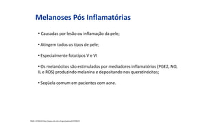 Melanoses Pós Inflamatórias
• Causadas por lesão ou inflamação da pele;
• Atingem todos os tipos de pele;
• Especialmente fototipos V e VI
• Os melanócitos são estimulados por mediadores inflamatórios (PGE2, NO,
IL e ROS) produzindo melanina e depositando nos queratinócitos;
• Seqüela comum em pacientes com acne.
PMID: 19706225http://www.ncbi.nlm.nih.gov/pubmed/19706225
 