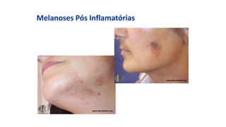 Melanoses Pós Inflamatórias
www.dermnetnz.org
www.dermnetnz.org
 