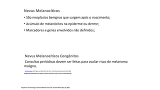 Nevus Melanocíticos
• São neoplasias benignas que surgem após o nascimento;
• Acúmulo de melanócitos na epiderme ou derme;
• Marcadores e genes envolvidos não definidos;
Nevus Melanocíticos Congênitos
Consultas periódicas devem ser feitas para avaliar risco de melanoma
maligno.
Clin Dermatol. 2010 May-Jun;28(3):293-302. doi: 10.1016/j.clindermatol.2010.04.004.
Congenital melanocytic nevi-when to worry and how to treat: Facts and controversies.
Fitzpatrick's Dermatology In General Medicine (Two Vol. Set) 6th edition (May 23, 2003)
 