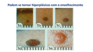 Podem se tornar hiperplásicos com o envelhecimento
 