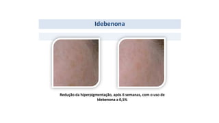 Idebenona
Redução da hiperpigmentação, após 6 semanas, com o uso de
Idebenona a 0,5%
 