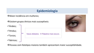 Epidemiologia
Maior incidência em mulheres;
Existem grupos étnicos mais susceptíveis:
Árabes;
Hindus;
Turcos;
Ibéricos;
Pessoas com fototipos maiores também apresentam maior susceptibilidade.
Vasos dilatados  Pálpebra mais escura .
 