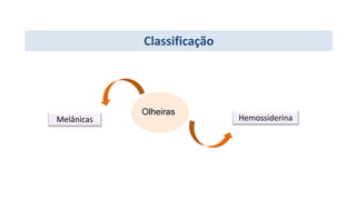 Classificação
Melânicas Hemossiderina
Olheiras
 